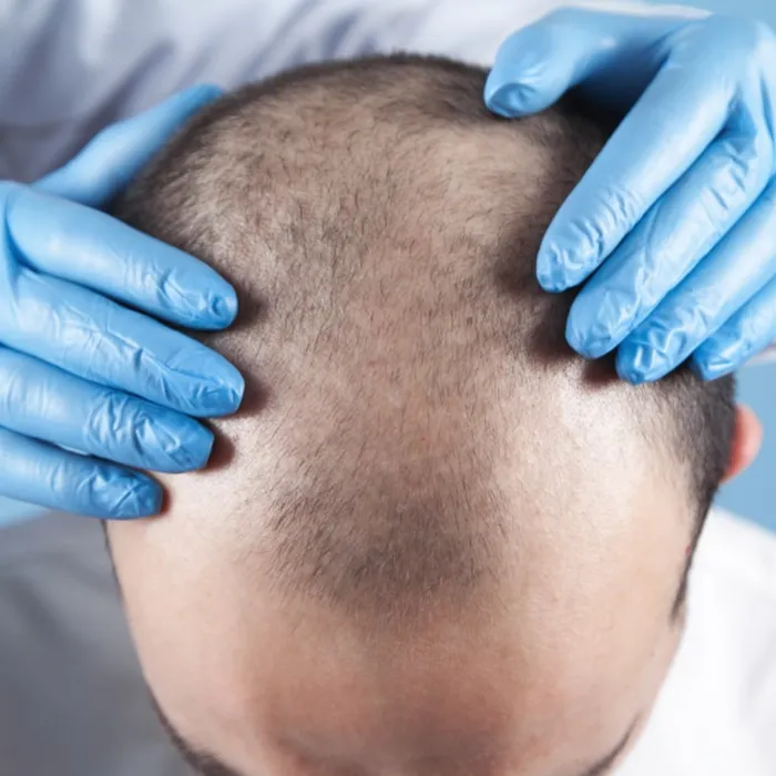 Greffe Capillaire FUE en Tunisie treatment visualization