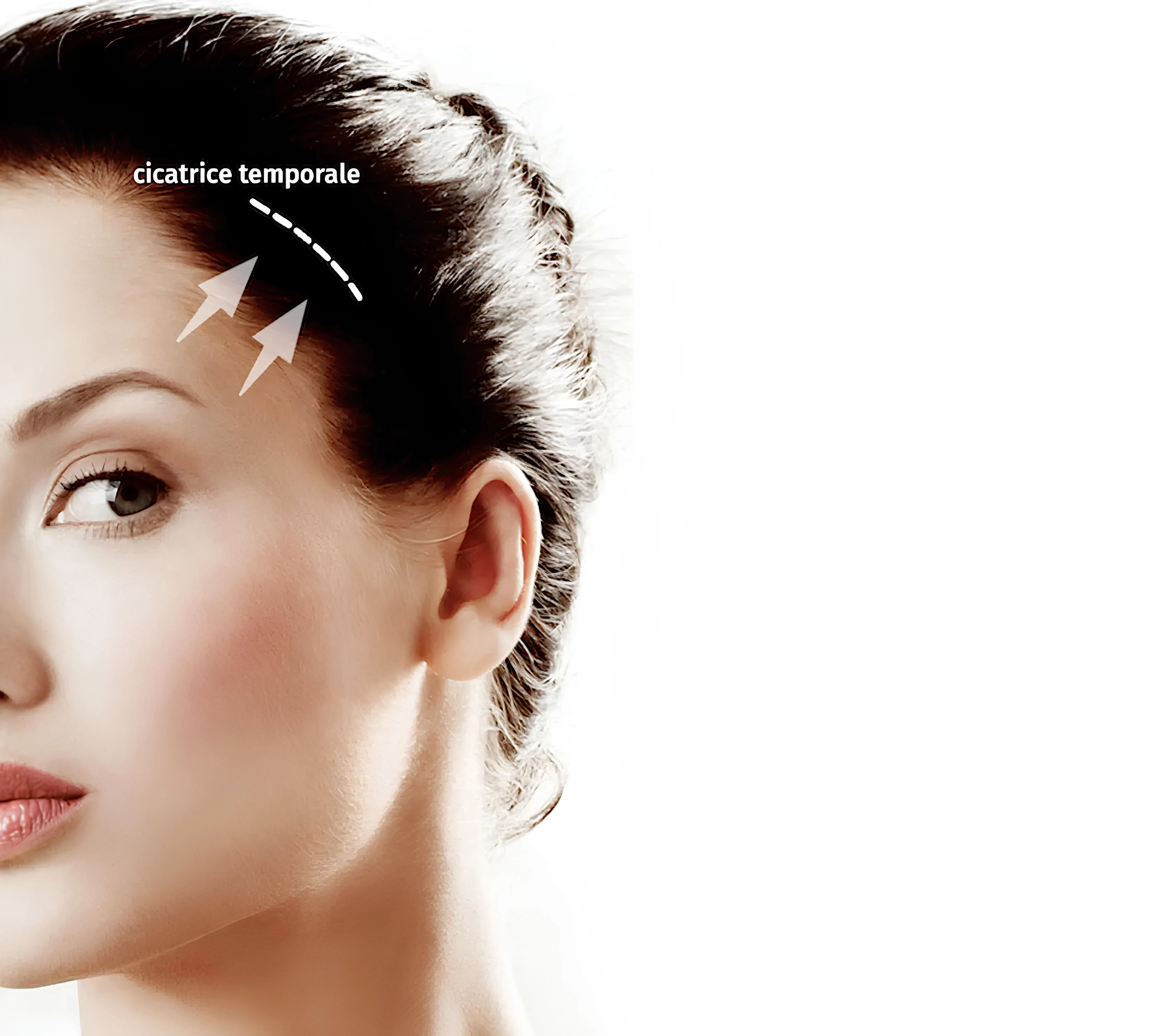 Lifting Temporal en Tunisie treatment visualization